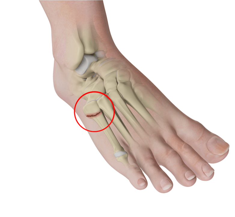 Jones Fracture Bunbury Foot Ankle Surgeon